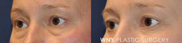 Before & After Eyelid Surgery Case 233 Left Oblique View in Buffalo, NY