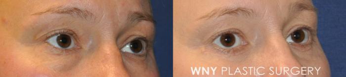 Before & After Eyelid Surgery Case 233 Right Oblique View in Buffalo, NY