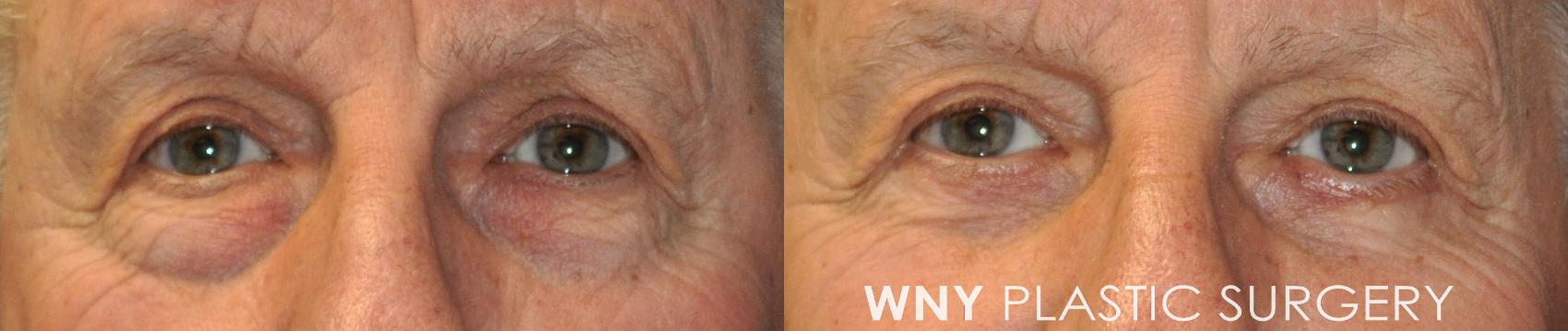 Before & After Eyelid Surgery Case 238 Front View in Buffalo, NY