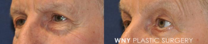 Before & After Eyelid Surgery Case 238 Left Oblique View in Buffalo, NY