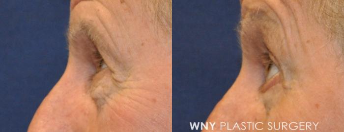 Before & After Eyelid Surgery Case 238 Left Side View in Buffalo, NY