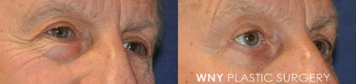 Before & After Eyelid Surgery Case 238 Right Oblique View in Buffalo, NY