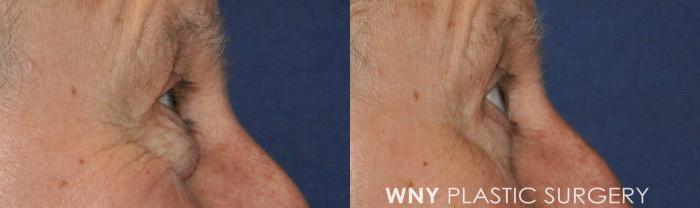 Before & After Eyelid Surgery Case 238 Right Side View in Buffalo, NY