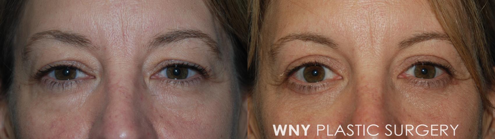 Before & After Eyelid Surgery Case 35 Front View in Williamsville, NY