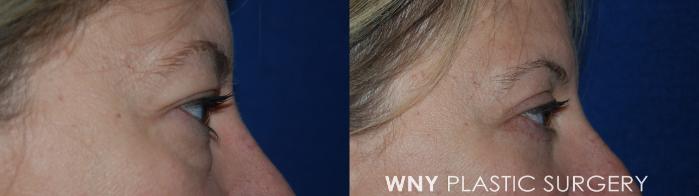 Before & After Eyelid Surgery Case 35 Right Side View in Williamsville, NY
