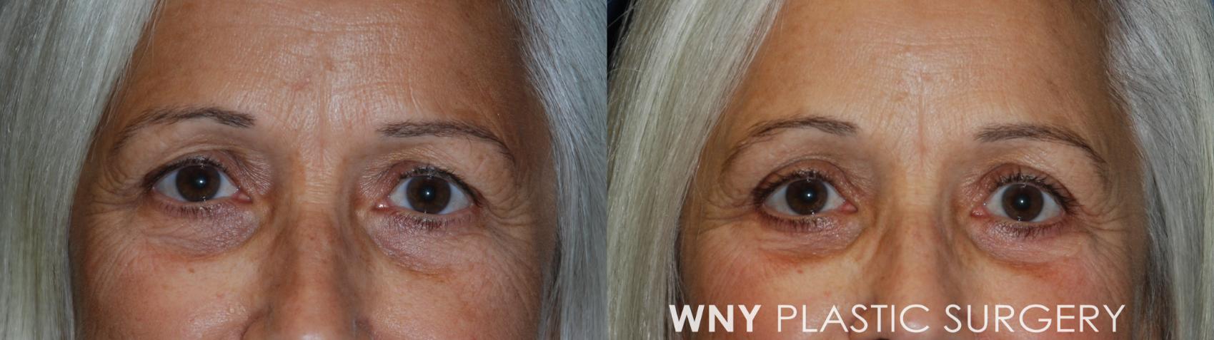 Before & After Eyelid Surgery Case 51 Front View in Williamsville, NY