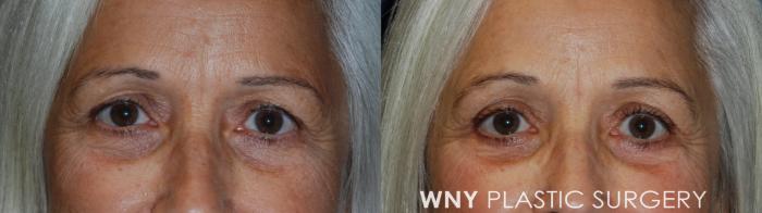 Before & After Eyelid Surgery Case 51 Front View in Buffalo, NY