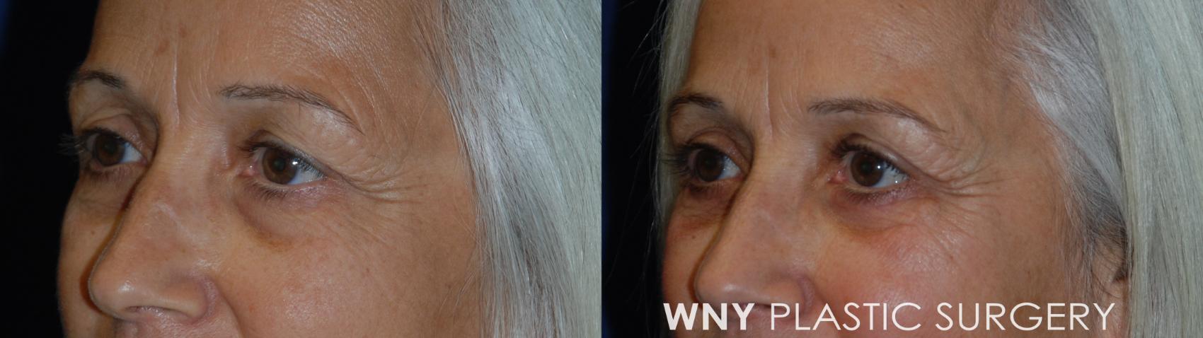 Before & After Eyelid Surgery Case 51 Left Oblique View in Williamsville, NY