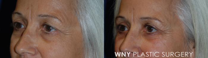 Before & After Eyelid Surgery Case 51 Left Oblique View in Buffalo, NY