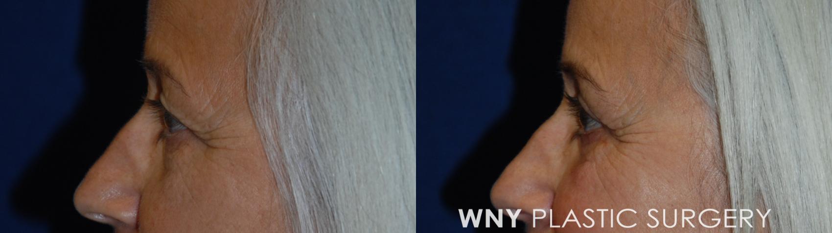 Before & After Eyelid Surgery Case 51 Left Side View in Williamsville, NY