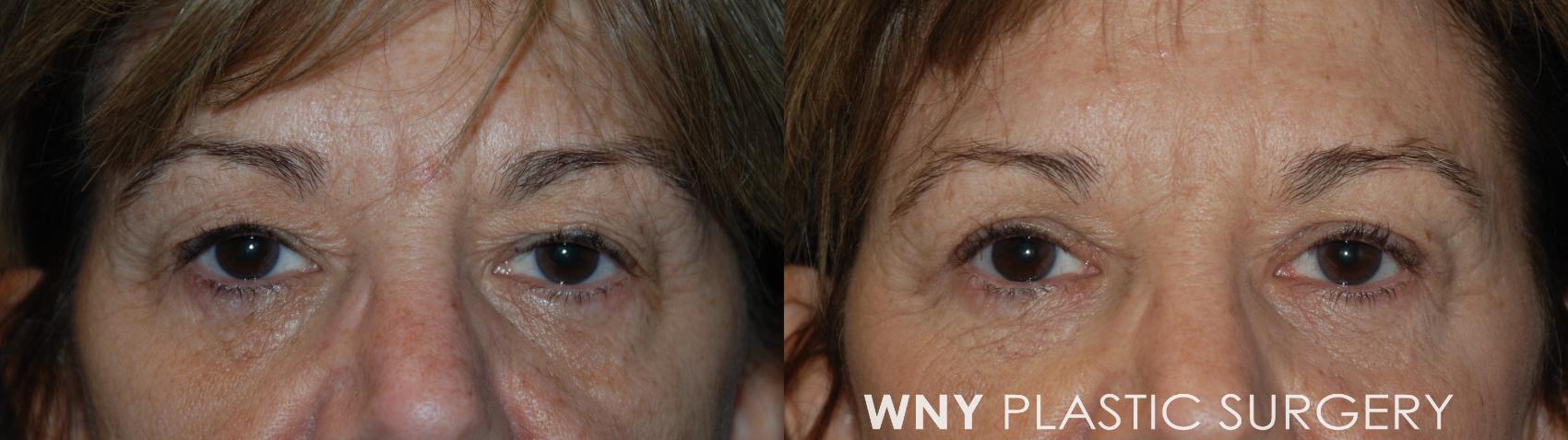 Before & After Eyelid Surgery Case 77 Front View in Williamsville, NY