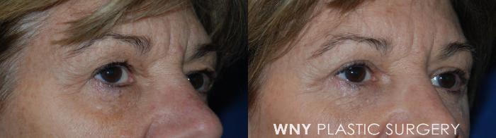 Before & After Eyelid Surgery Case 77 Right Oblique View in Williamsville, NY