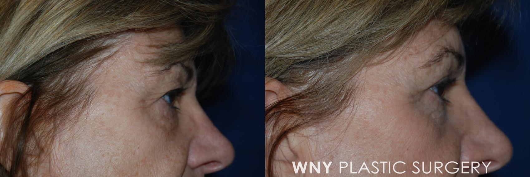 Before & After Eyelid Surgery Case 77 View #3 View in Williamsville, NY