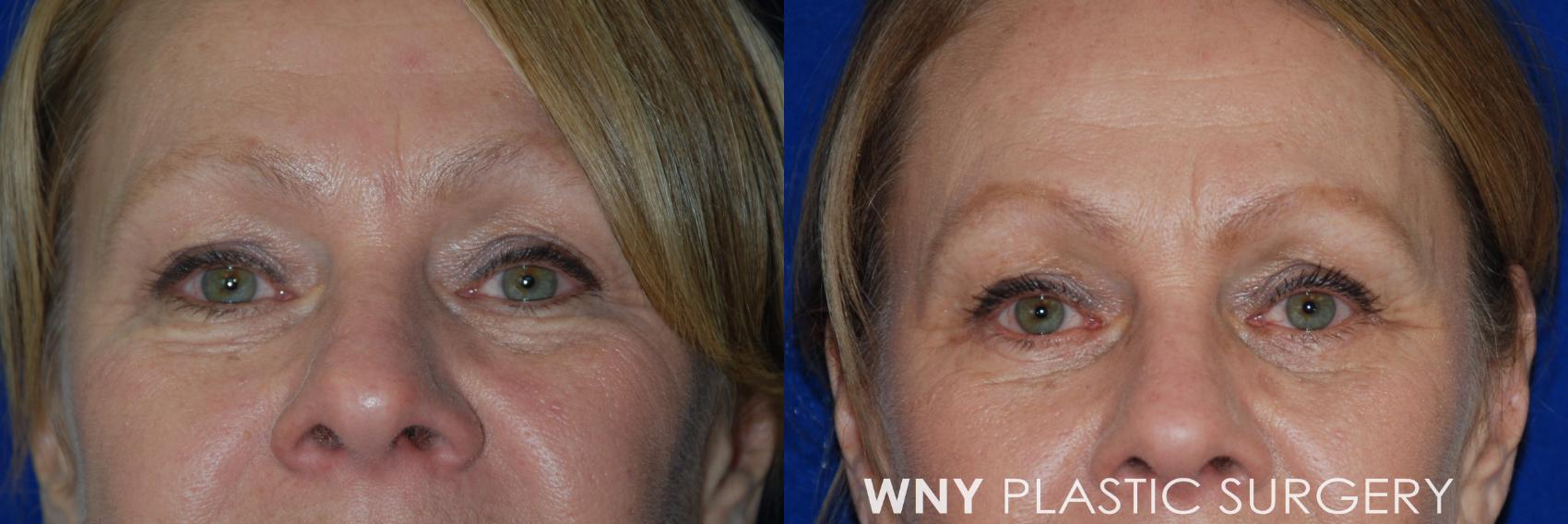 Before & After Eyelid Surgery Case 78 View #1 View in Williamsville, NY