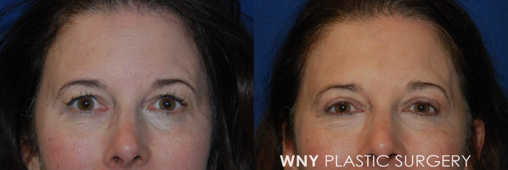 Before & After Eyelid Surgery Case 79 View #1 View in Williamsville, NY