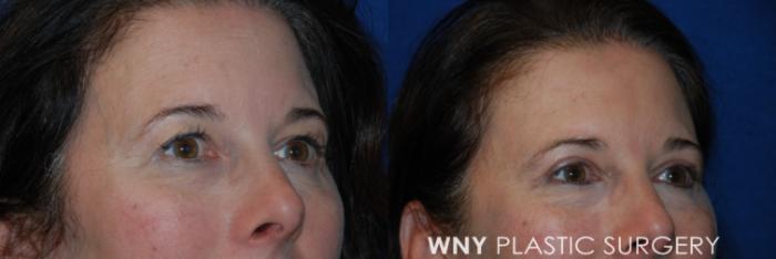 Before & After Eyelid Surgery Case 79 View #2 View in Williamsville, NY