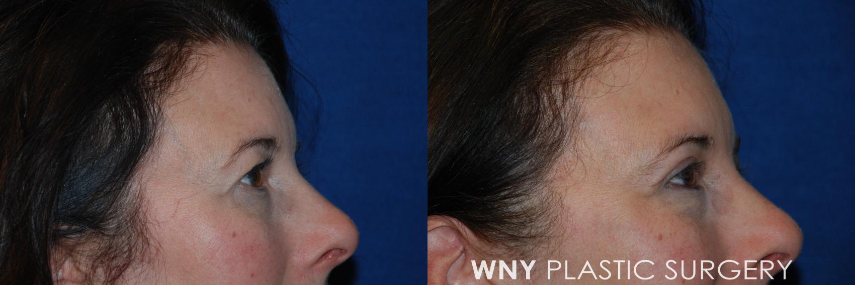 Before & After Eyelid Surgery Case 79 View #3 View in Williamsville, NY