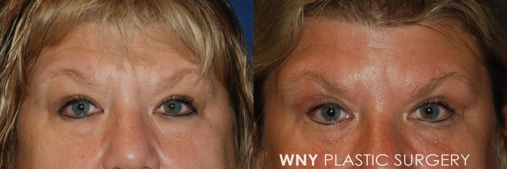 Before & After Eyelid Surgery Case 93 View #1 View in Williamsville, NY