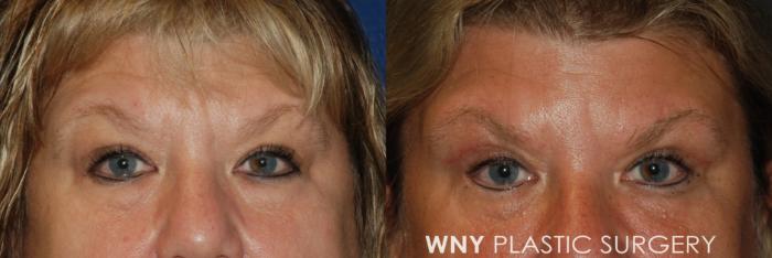 Before & After Eyelid Surgery Case 93 View #1 View in Buffalo, NY