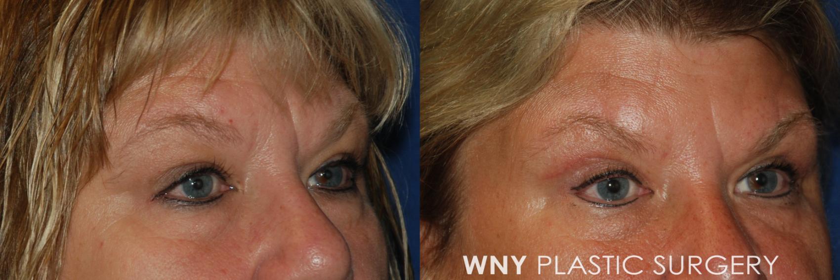 Before & After Eyelid Surgery Case 93 View #2 View in Williamsville, NY