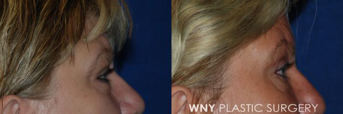 Before & After Eyelid Surgery Case 93 View #3 View in Buffalo, NY