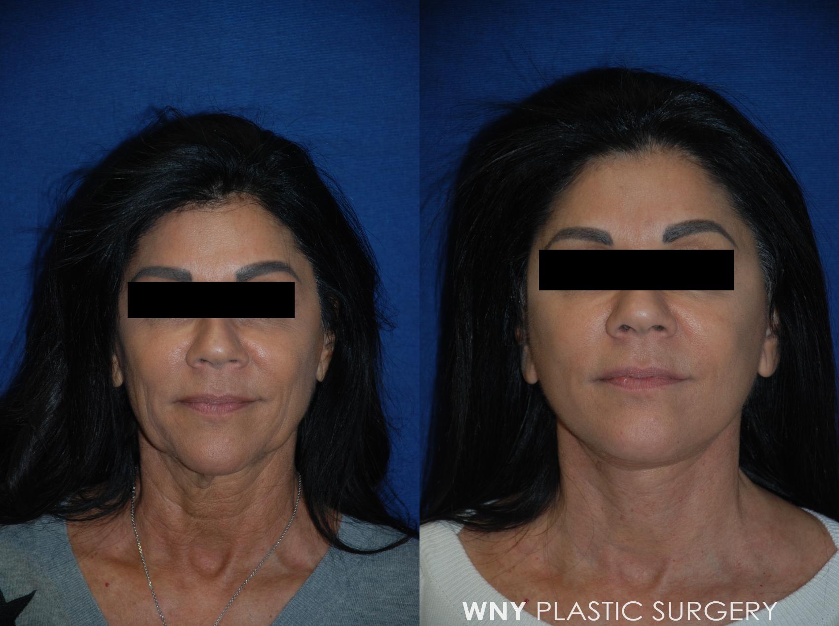 Before & After Facelift Case 105 View #1 View in Williamsville, NY