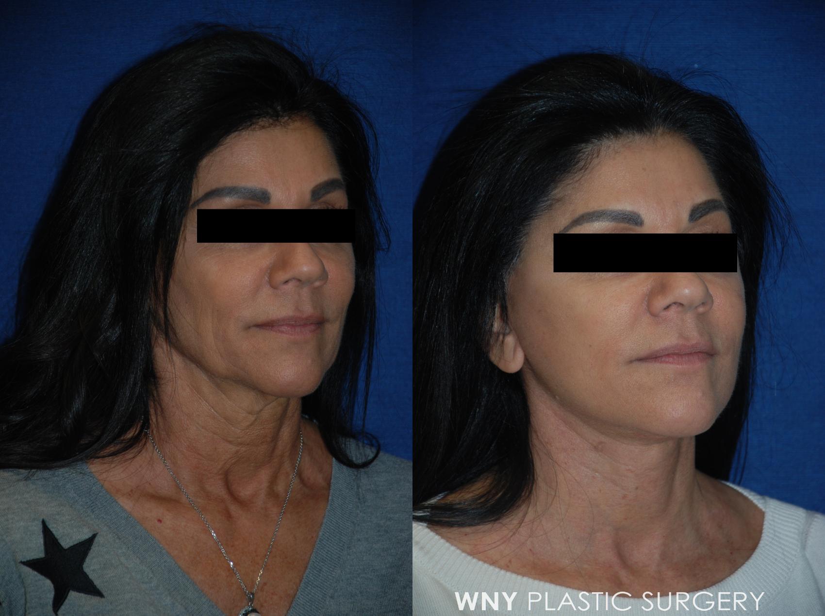 Before & After Facelift Case 105 View #2 View in Williamsville, NY
