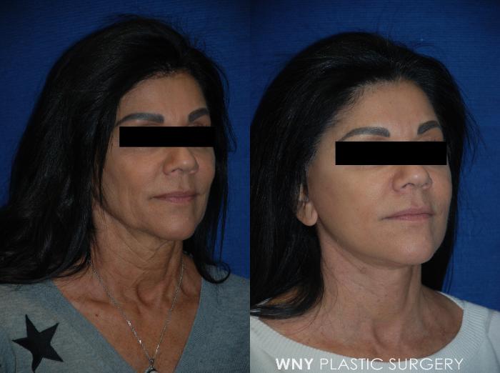 Before & After Facelift Case 105 View #2 View in Buffalo, NY