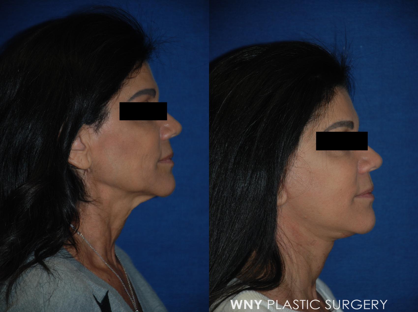 Before & After Facelift Case 105 View #3 View in Williamsville, NY
