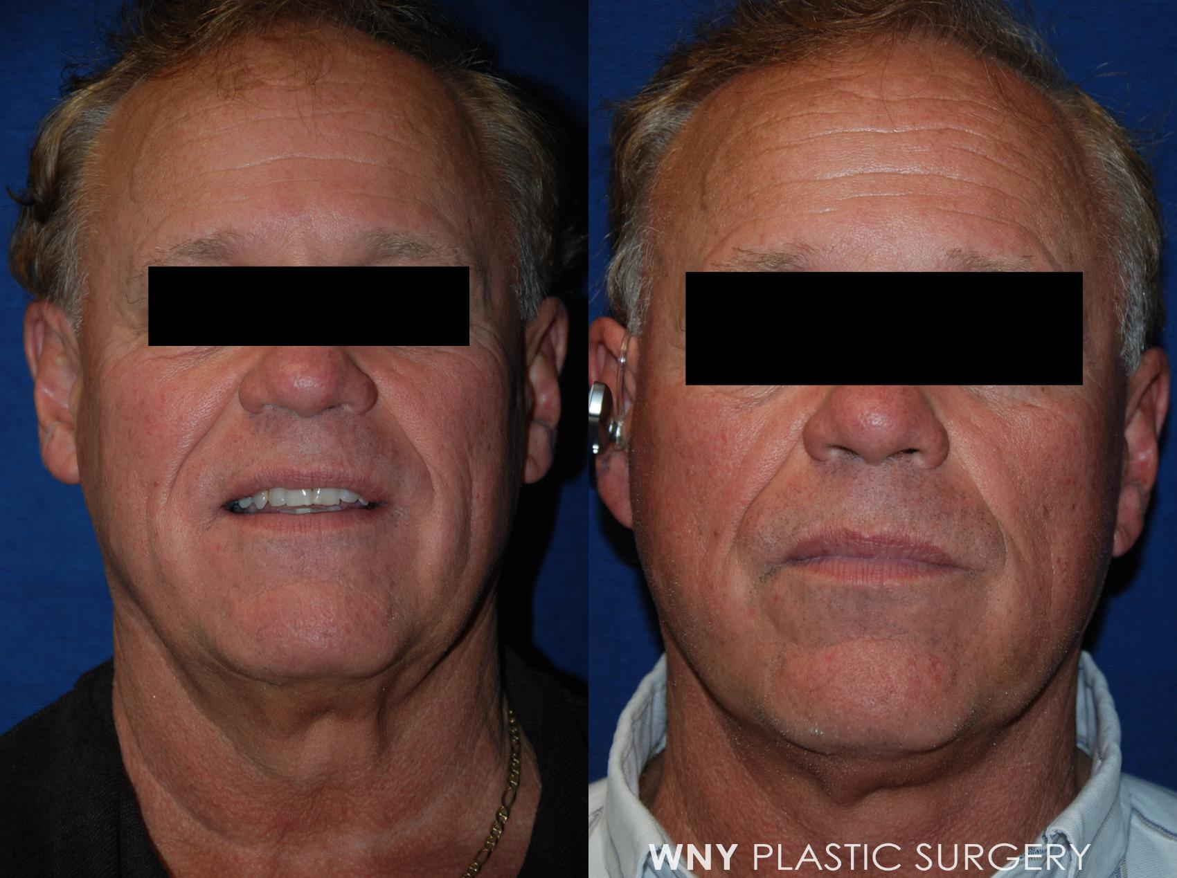Before & After Facelift Case 108 View #1 View in Williamsville, NY