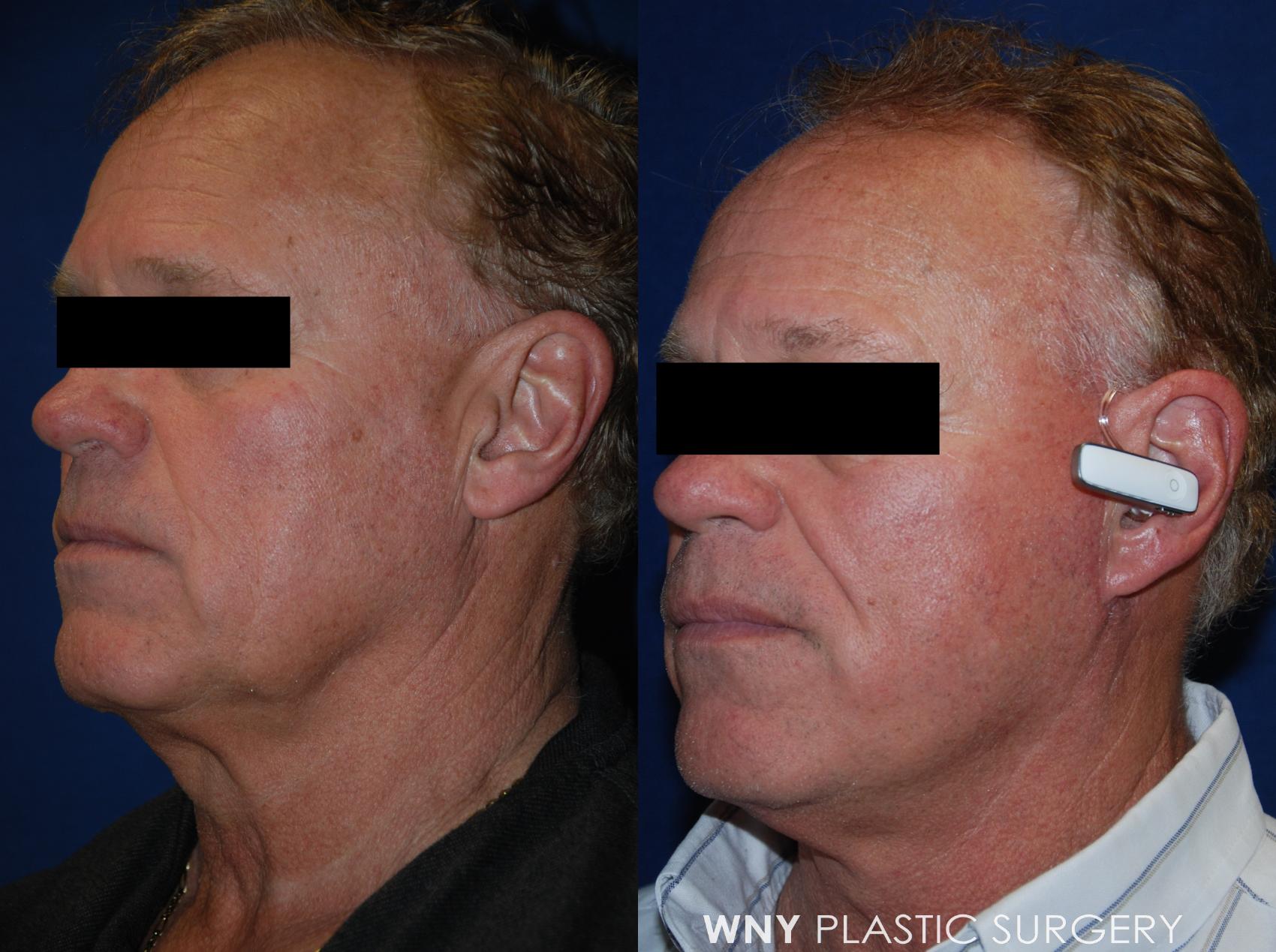 Before & After Facelift Case 108 View #2 View in Williamsville, NY