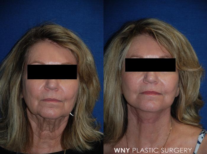 Before & After Facelift Case 113 View #1 View in Buffalo, NY