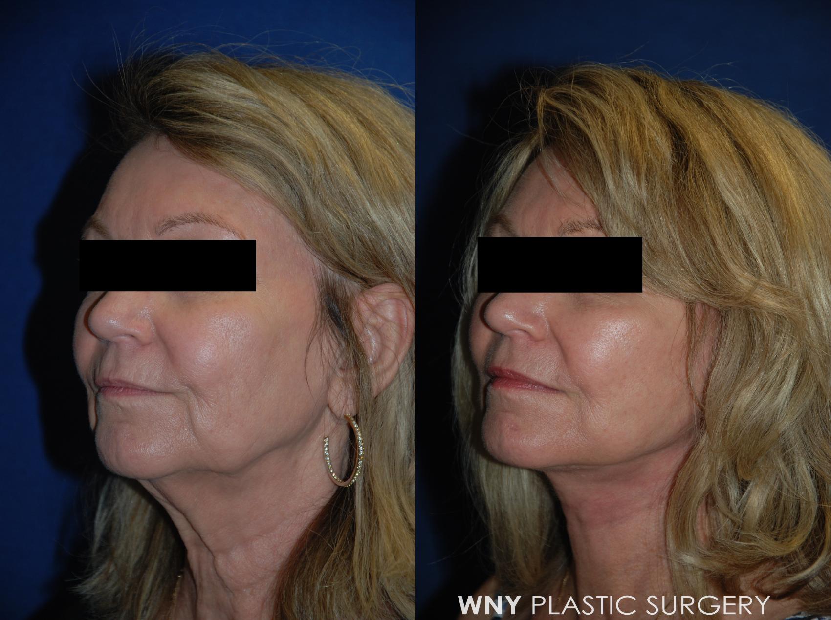Before & After Facelift Case 113 View #2 View in Williamsville, NY