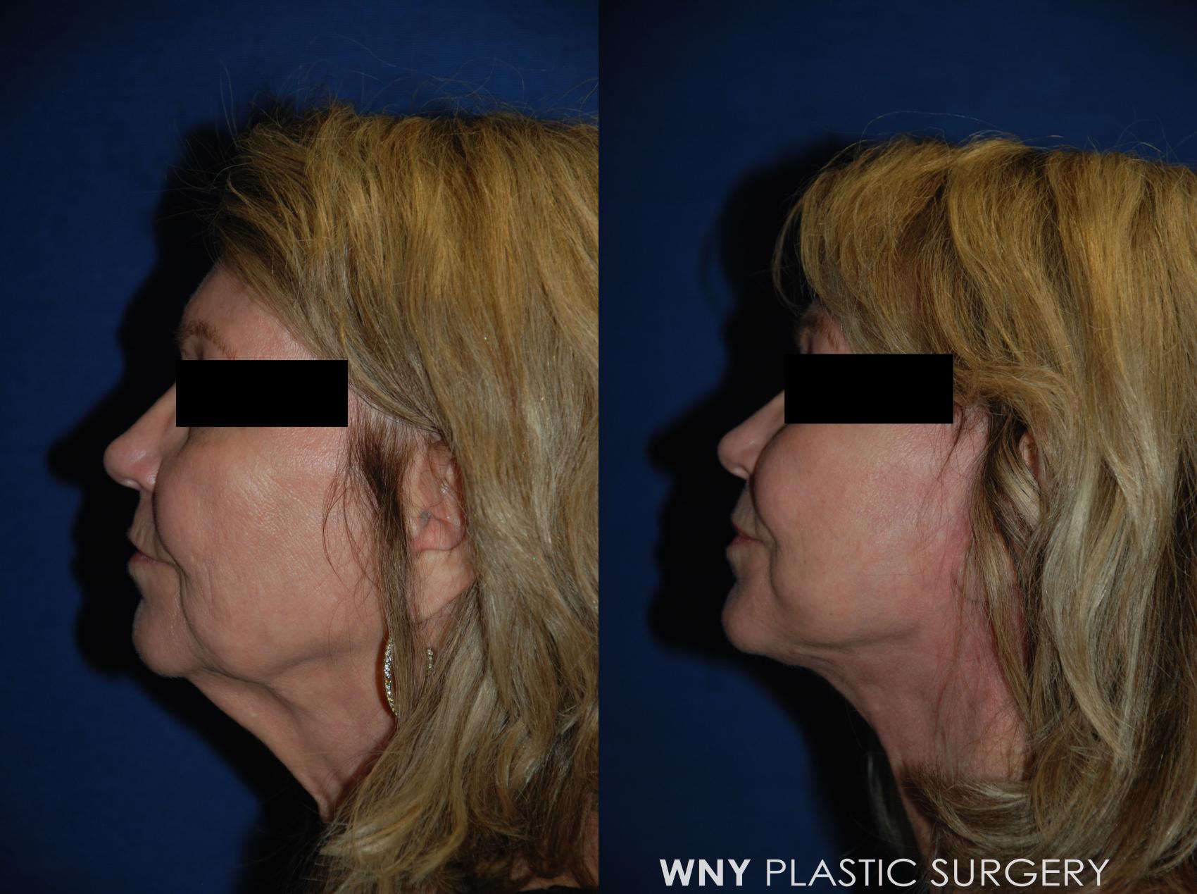 Before & After Facelift Case 113 View #3 View in Williamsville, NY