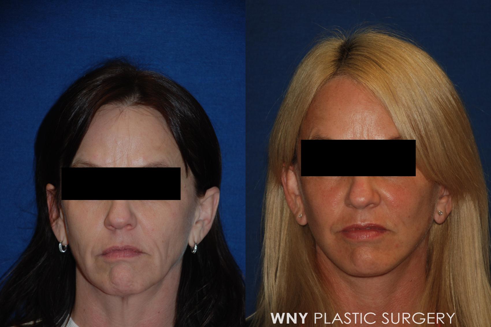 Before & After Facelift Case 157 View #1 View in Williamsville, NY
