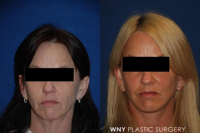 Before & After Facelift Case 157 View #1 View in Buffalo, NY