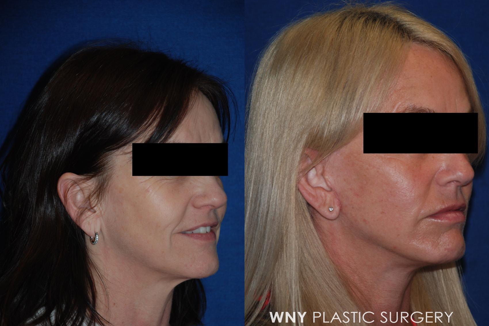 Before & After Facelift Case 157 View #2 View in Williamsville, NY