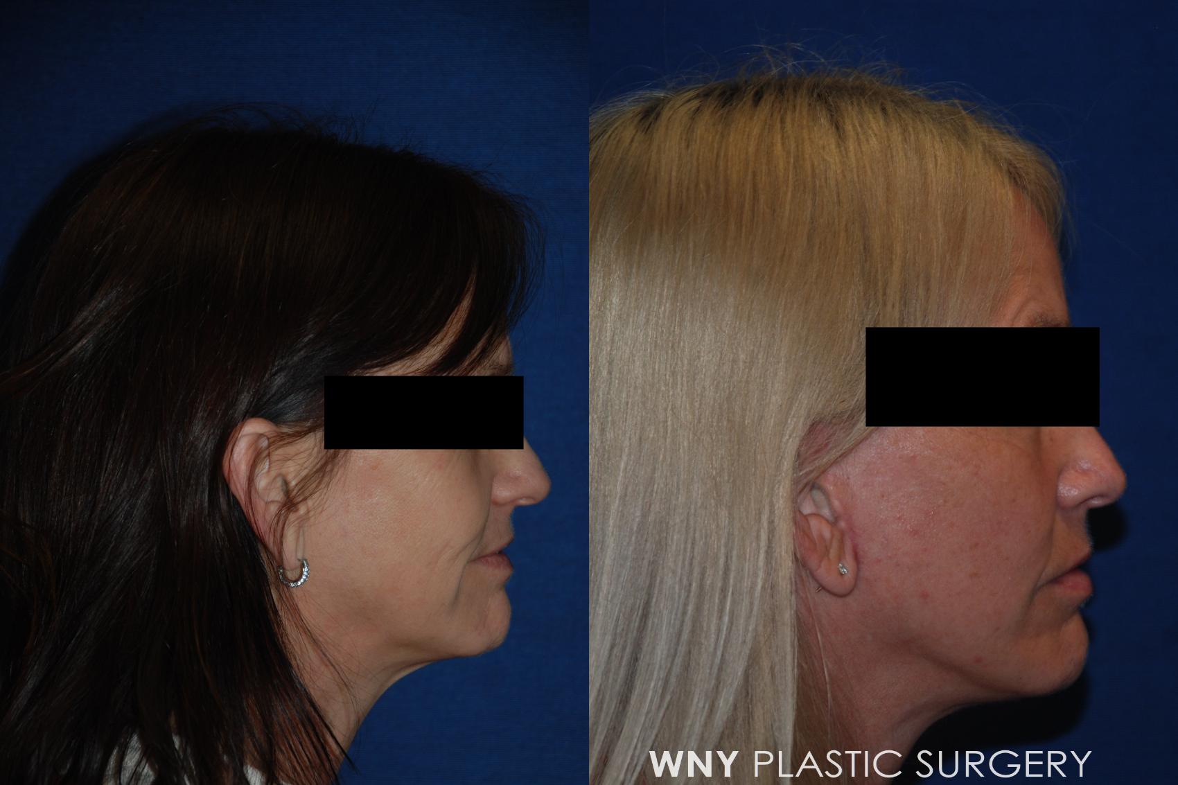 Before & After Facelift Case 157 View #3 View in Williamsville, NY