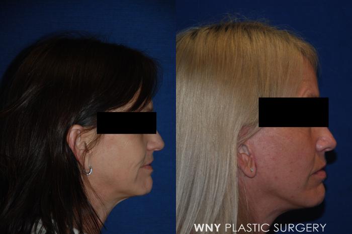 Before & After Facelift Case 157 View #3 View in Buffalo, NY