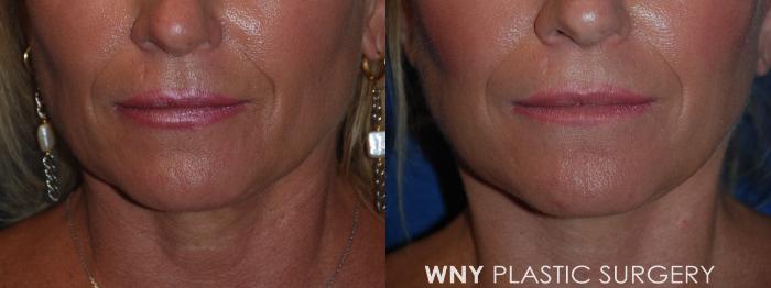 Before & After Facelift Case 181 Front View in Williamsville, NY