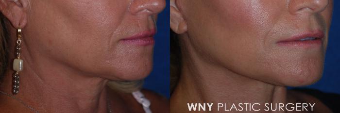 Before & After Facelift Case 181 Right Oblique View in Buffalo, NY