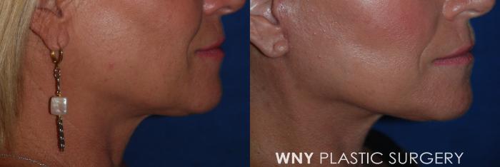 Before & After Facelift Case 181 Right Side View in Buffalo, NY