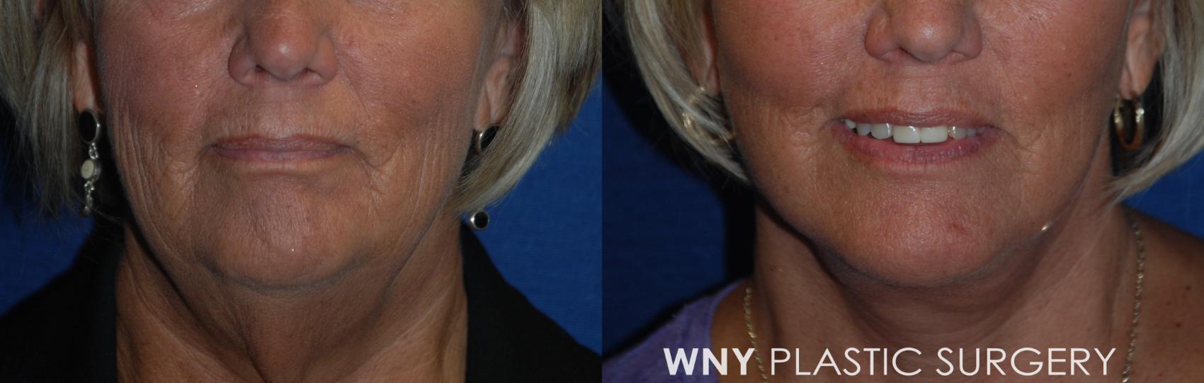 Before & After Facelift Case 183 Front View in Williamsville, NY