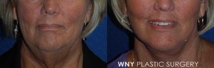 Before & After Facelift Case 183 Front View in Williamsville, NY