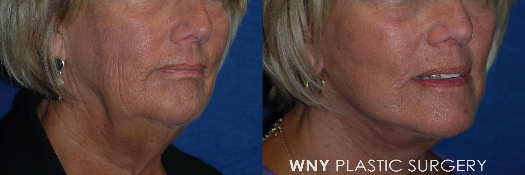 Before & After Facelift Case 183 Left Oblique View in Williamsville, NY