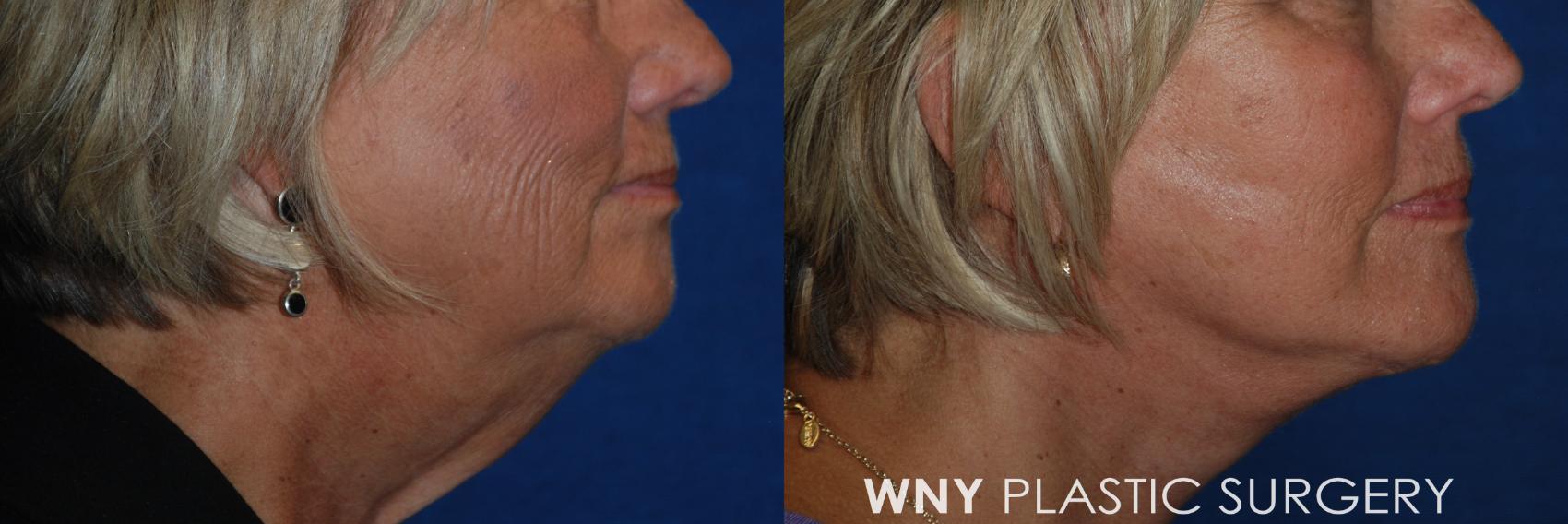 Before & After Facelift Case 183 Left Side View in Williamsville, NY
