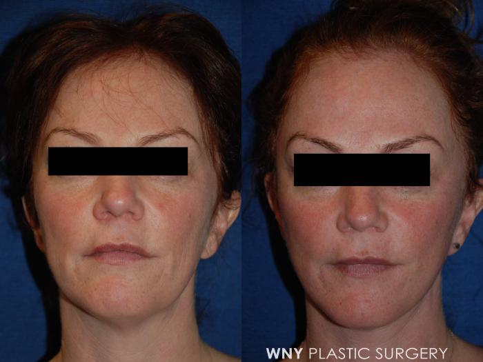 Before & After Facelift Case 189 Front View in Williamsville, NY