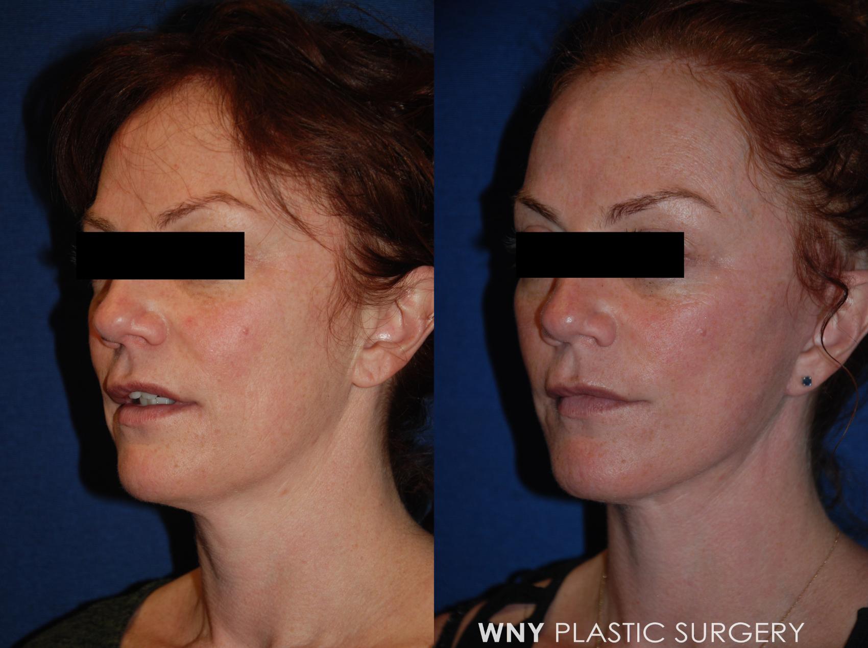 Before & After Facelift Case 189 Left Oblique View in Williamsville, NY