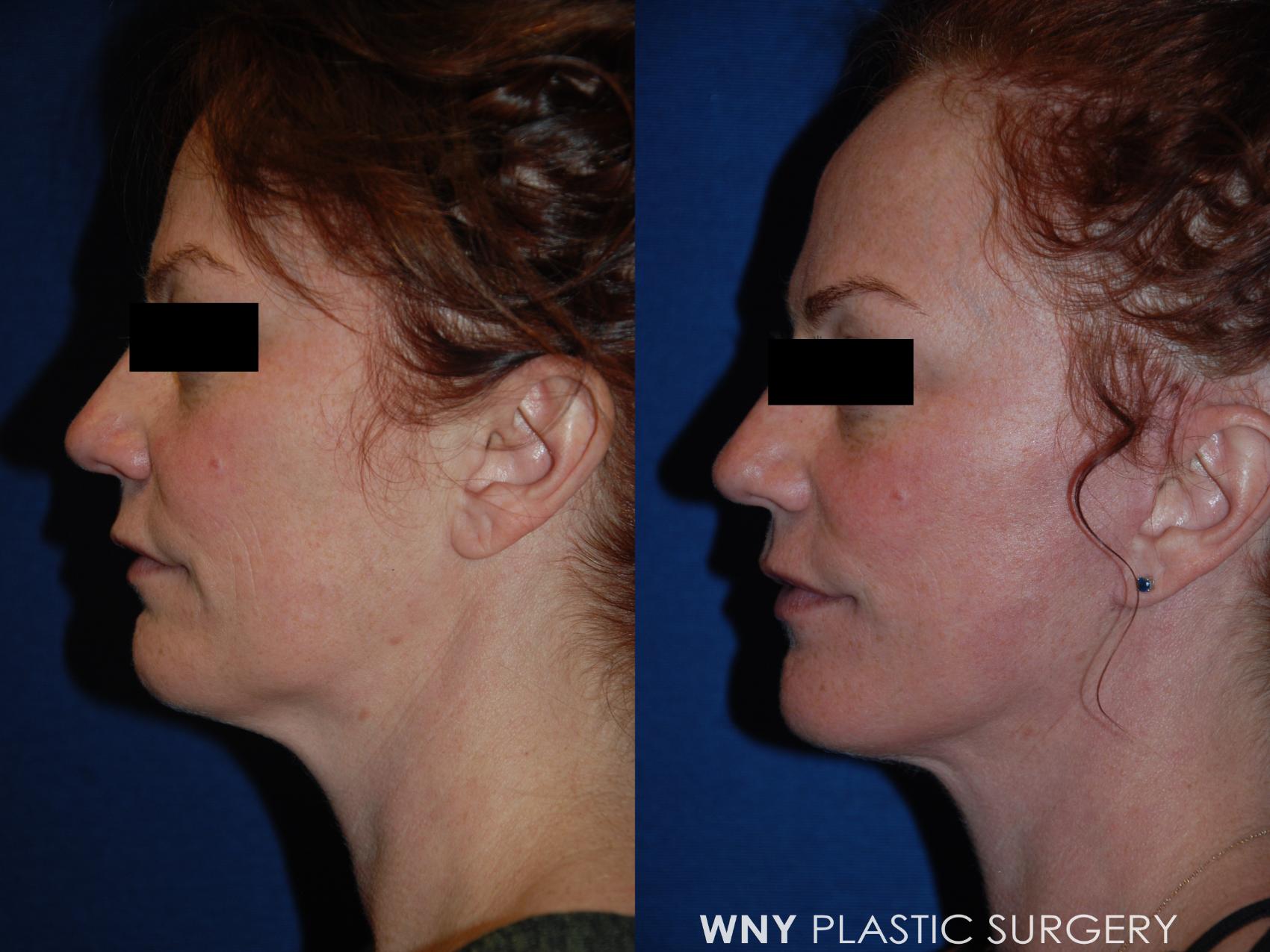 Before & After Facelift Case 189 Left Side View in Williamsville, NY