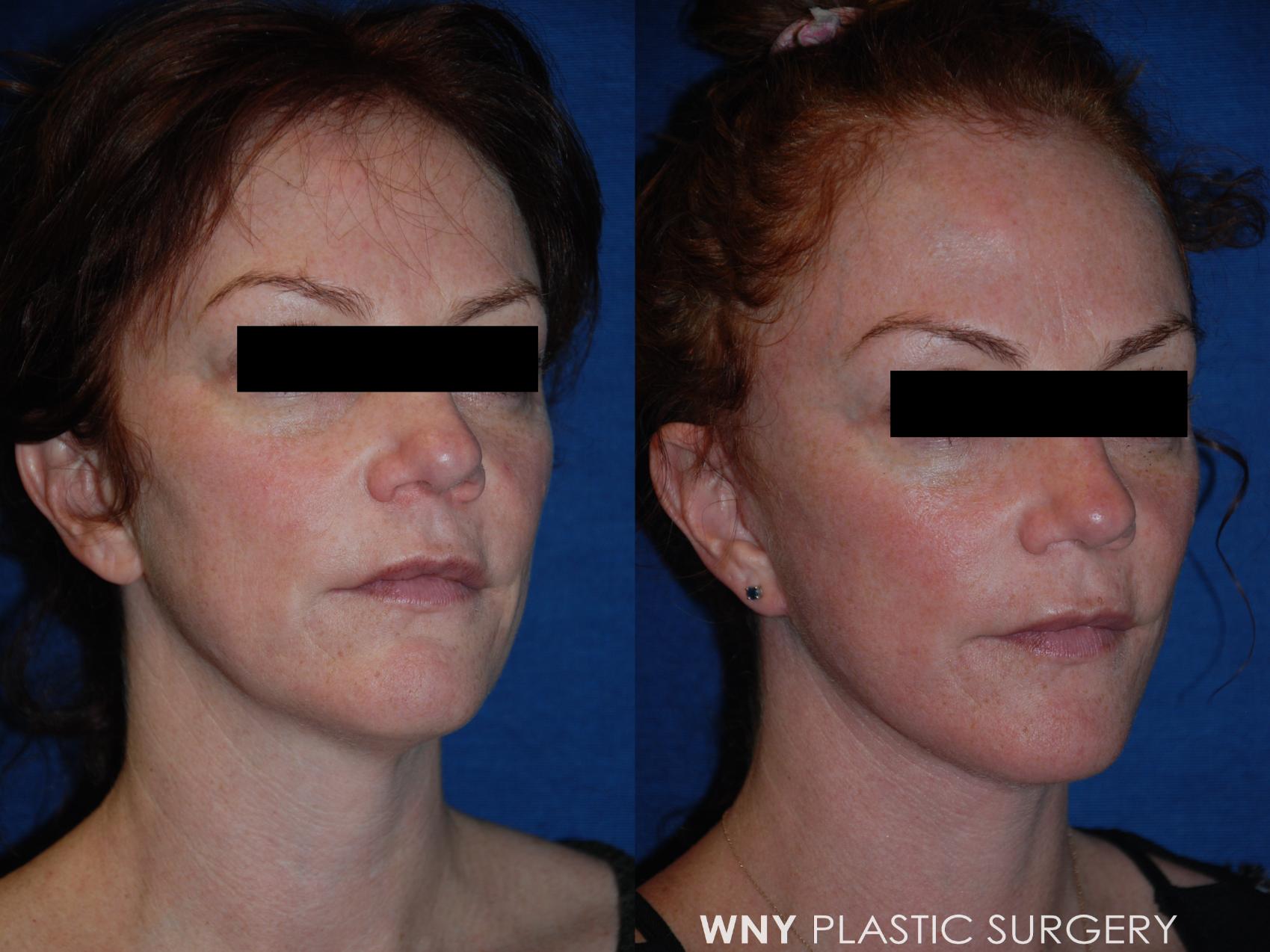 Before & After Facelift Case 189 Right Oblique View in Williamsville, NY
